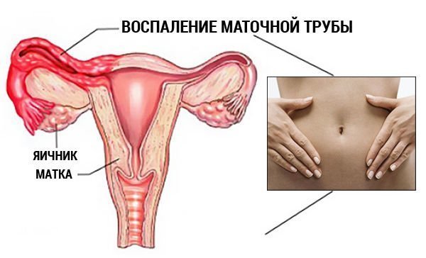 Как выглядит аднексит?