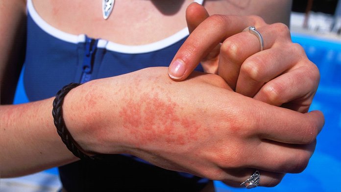 Пятна на коже от солнце