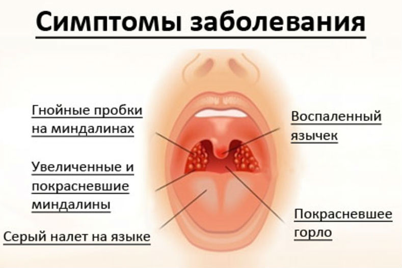 Симптомы абсцесса горла