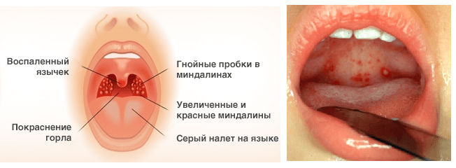 Ангина