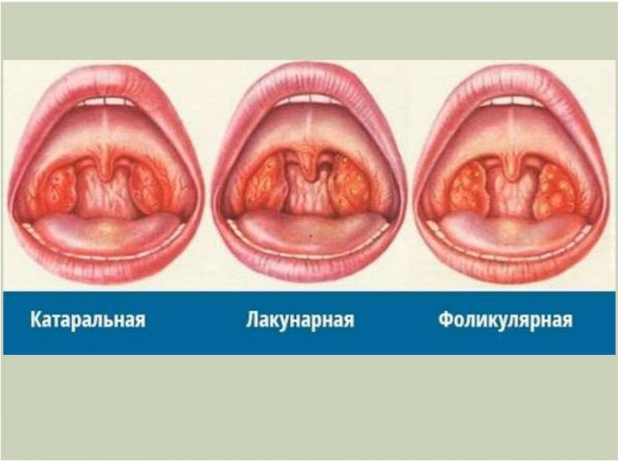 Виды ангины