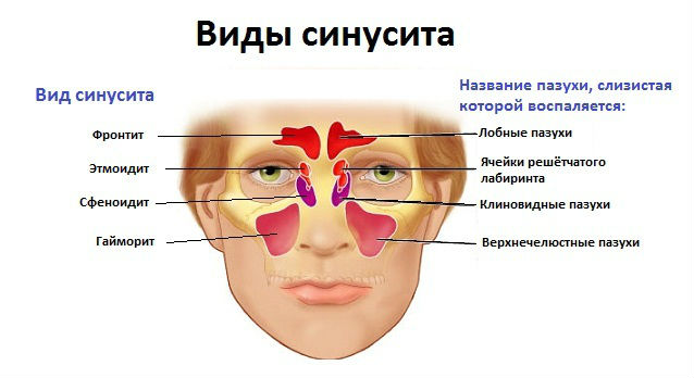 Виды синусита Виды синусита