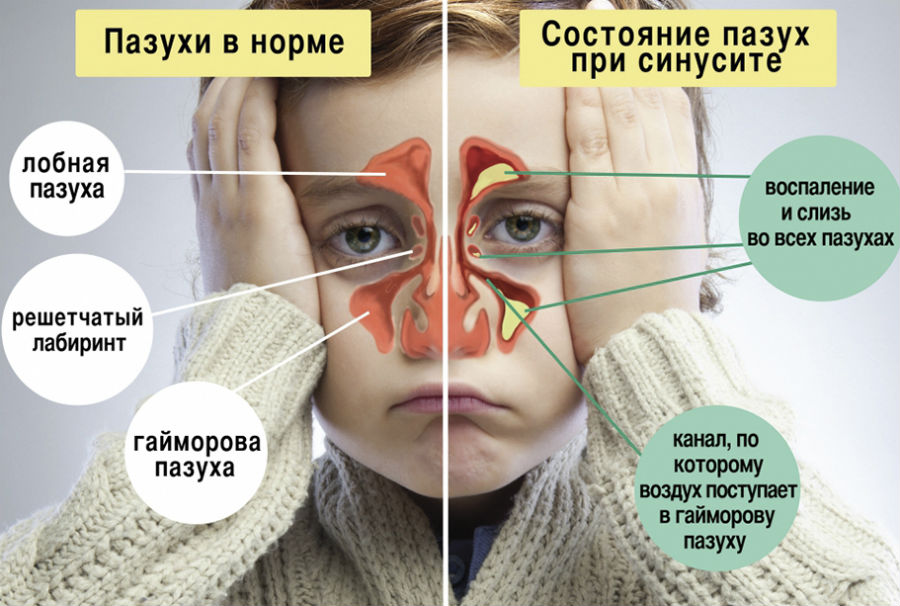 Синусит Синусит