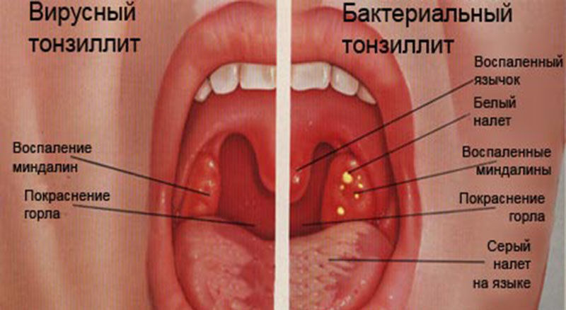 Отличия вирусного и бактериального тонзиллита
