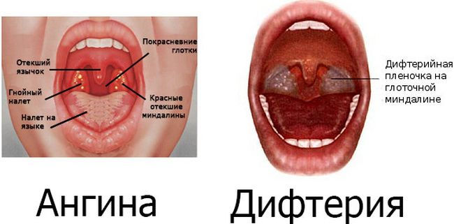 Отличия ангины от дифтерии