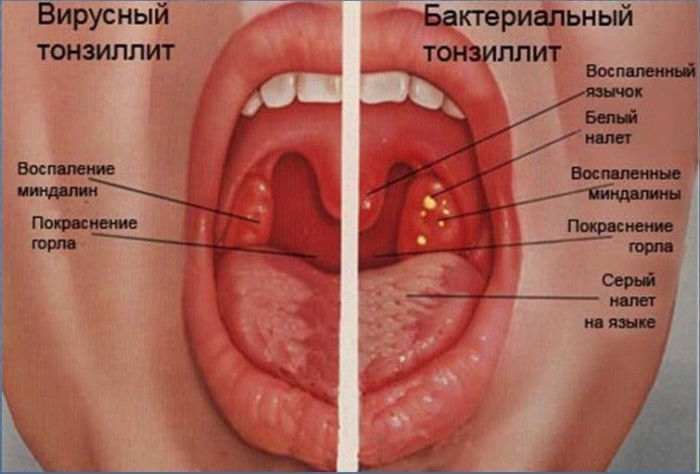 Вирусный и бактериальный тонзиллит Вирусный и бактериальный тонзиллит