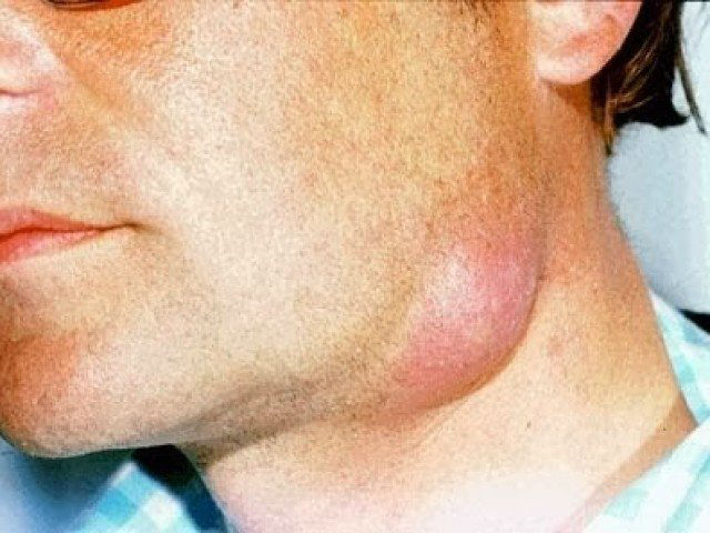 Лимфаденит Лимфаденит