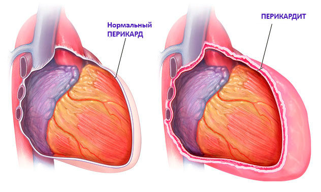 Перикардит
