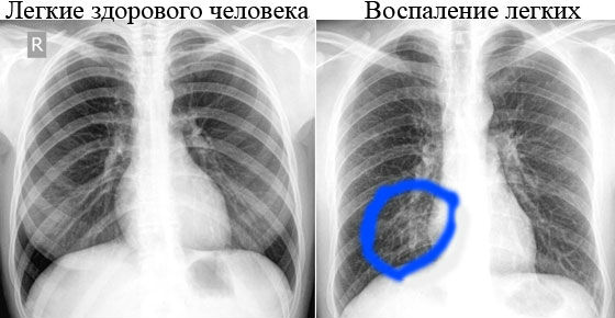 Рентген легких