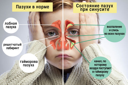 Носовые пазухи при синусите