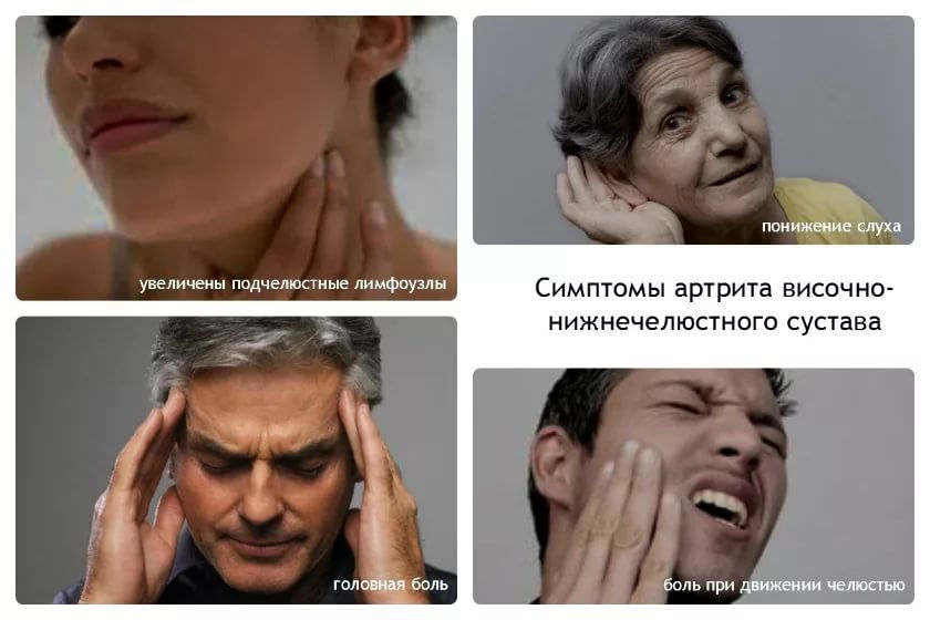 Артрит нижнечелюстного сустава