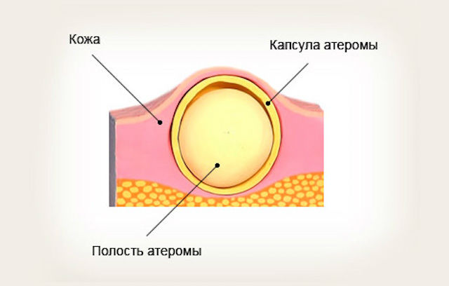 Атерома