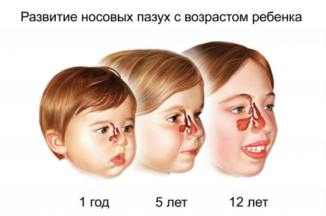 Развитие носовых пазух у детей Развитие носовых пазух у детей