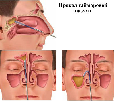 Пункция гайморовой пазухи Пункция гайморовой пазухи