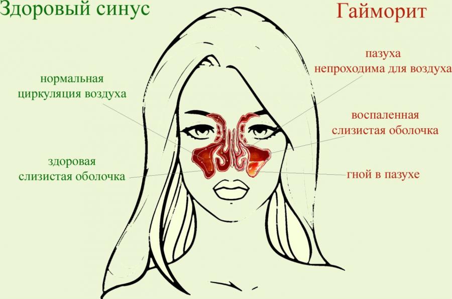 Гайморит