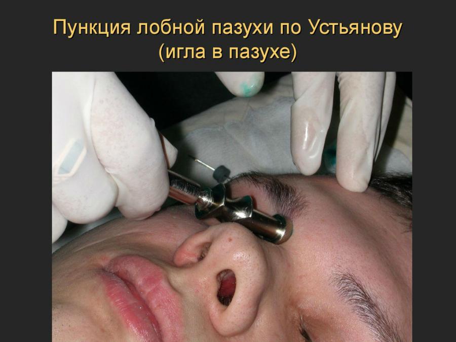 Пункция лобной пазухи
