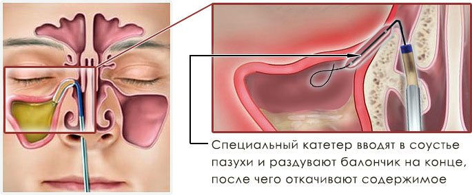 Балонная синусопластика