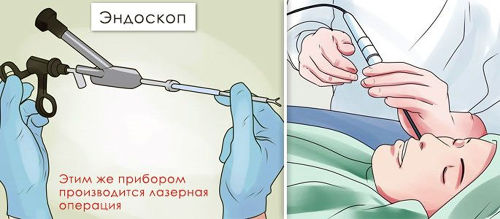 Эндоскопия носа