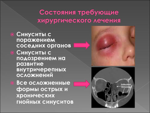 Осложнения от гайморита