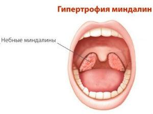 Гипертрофия миндалин