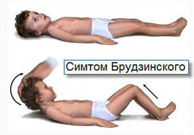 Симптом Брудзинского