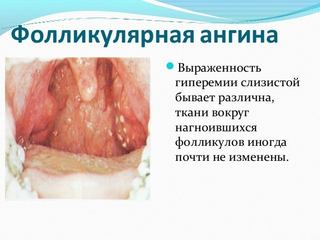 Фолликулярная ангина