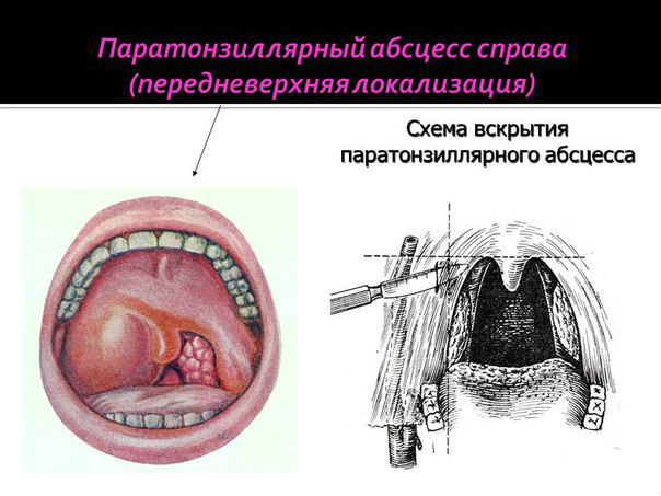 Вскрытие абсцесса миндалины