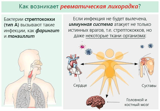 Ревматическая лихорадка