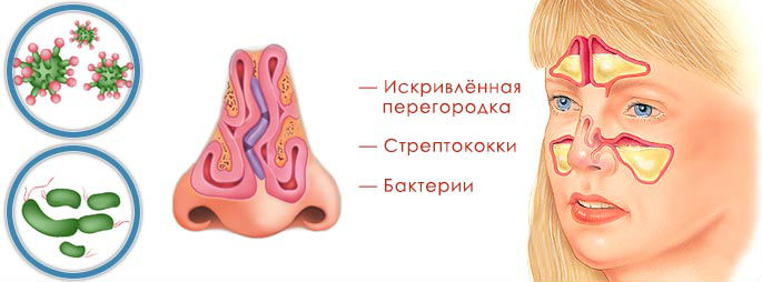 Гнойный гайморит Гнойный гайморит
