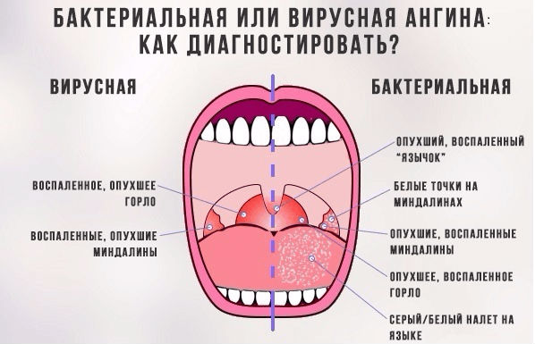 Бактериальная и вирусная ангина