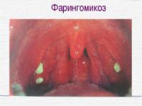 Фарингомикоз