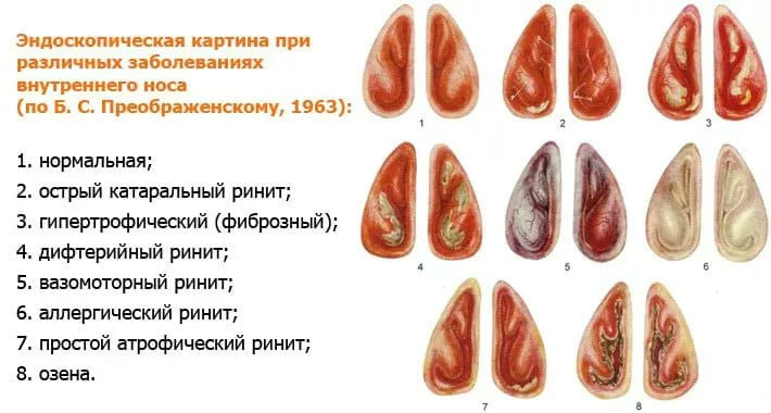 Раковины при разных формах ринита