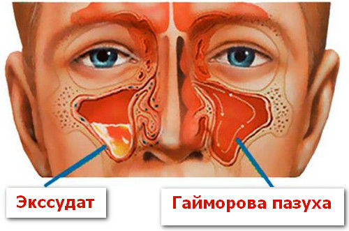 Синусит