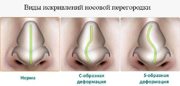 Виды деформаций носовой перегородки