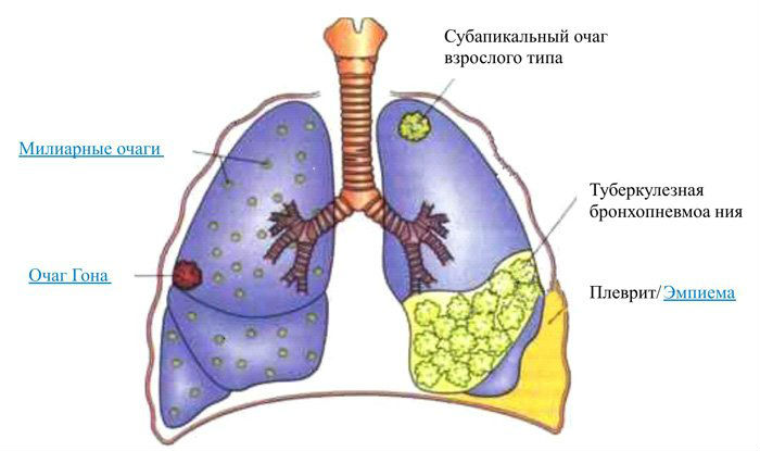 Туберкулез
