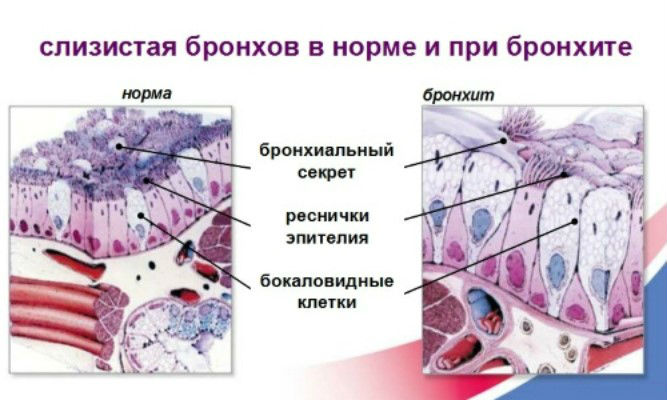 Слизистая бронхов при бронхите