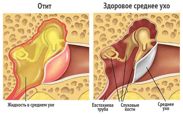 Схема здорового и воспаленного уха