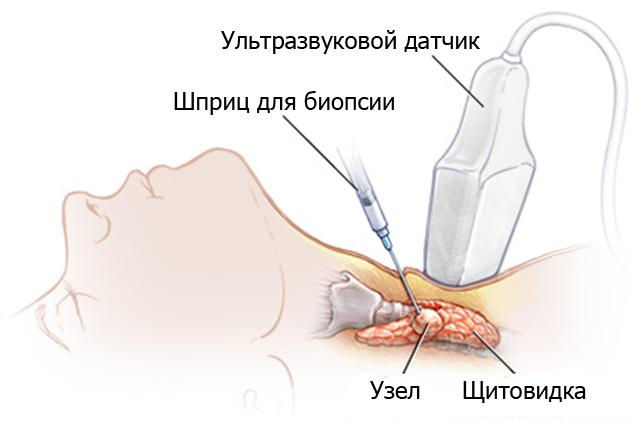 Биопсия щитовидной железы