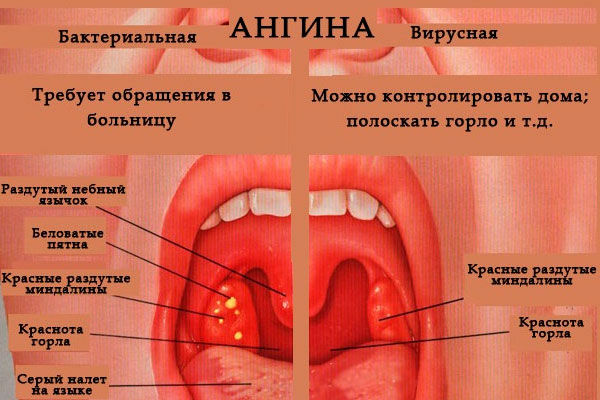 Бактериальная и вирусная ангина