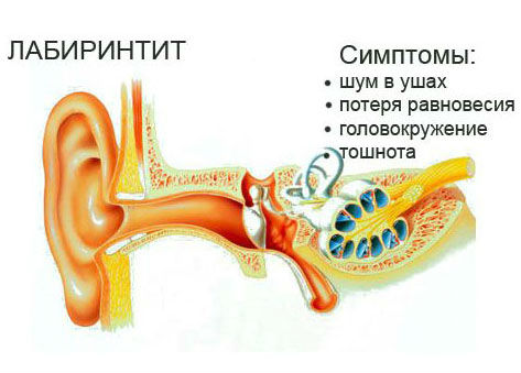 Симптомы лабиринтита