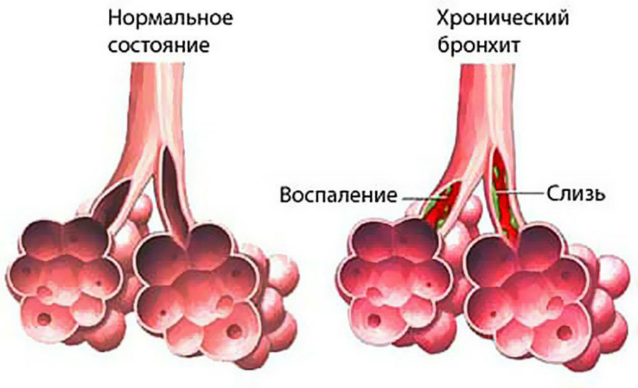 Хронический бронхит Хронический бронхит