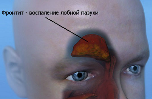 Фронтит Фронтит