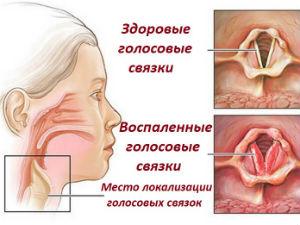 Ларингит