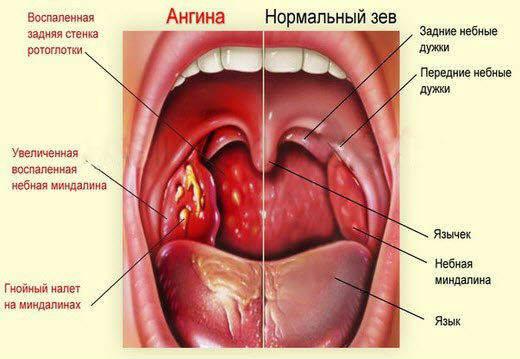 Ангина Ангина