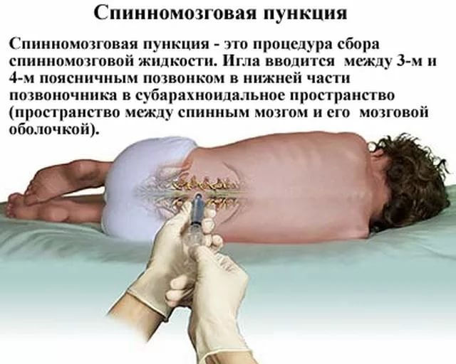 Спинномозговая пункция