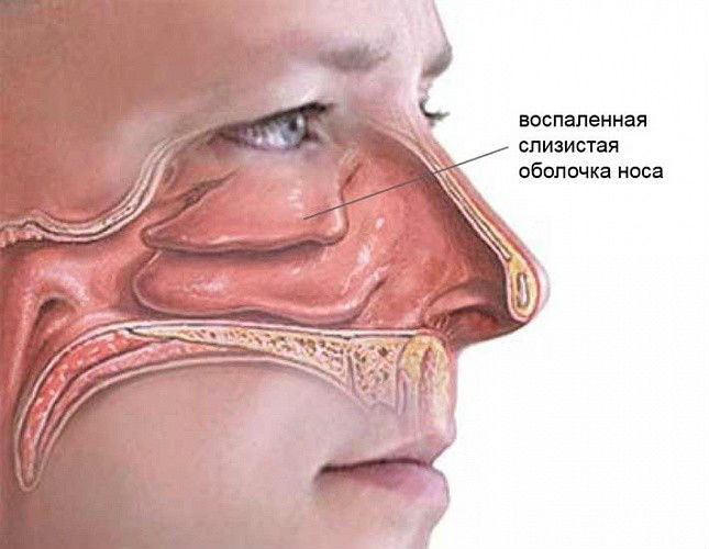 Ринит
