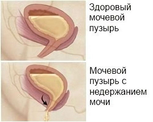 Недержание мочи