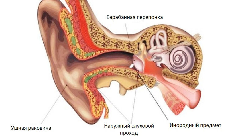 Инородное тело в ухе