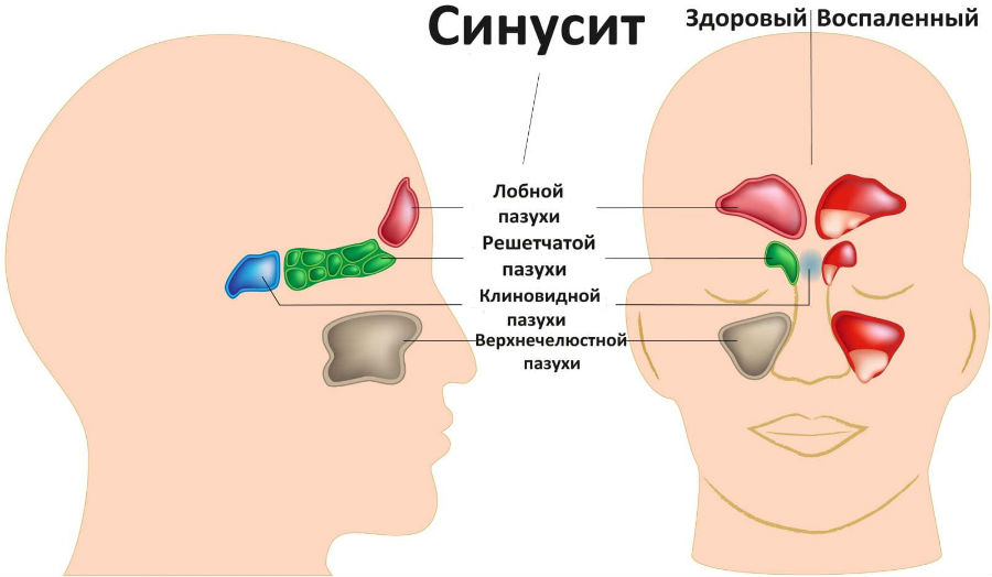 Виды синусита Виды синусита