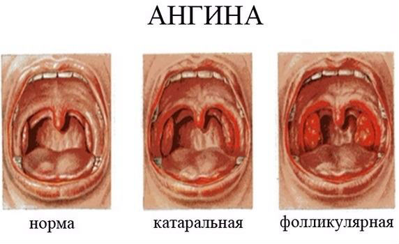 Виды ангины